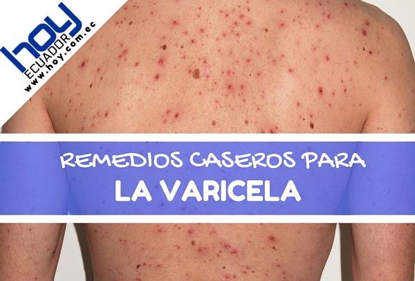 remedios naturales para la varicela